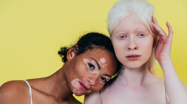 Serupa Tapi Tak Sama, Ini Perbedaan Vitiligo dengan Albinisme atau Albino