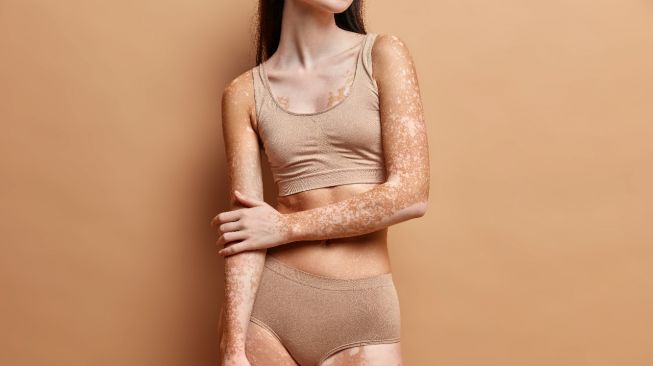 Stigma Kutukan Bisa Sebabkan Pengidap Vitiligo Alami Gangguan Psikologis