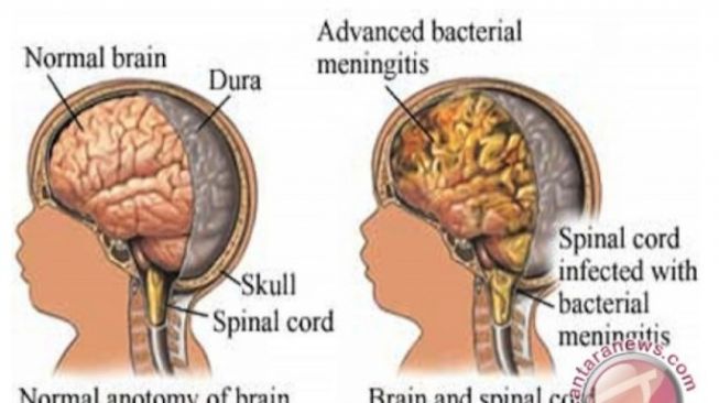 Gejala Penyakit Meningitis Ini Perlu Anda Ketahui Sebelum Terlambat