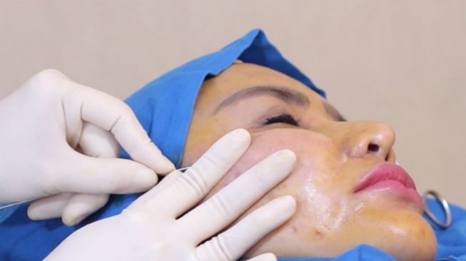 Pengencangan wajah dengan metode tarik benang Aptos. (Foto: Dok. Klinik Dermaster Indonesia)