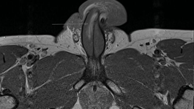 Penis patah. (Dok: BMJ Case Reports)