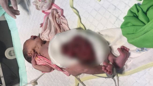 Sedih, Bayi di Kutim Lahir Tanpa Dinding Perut, Usus Keluar Lewat Lubang Samping Pusar