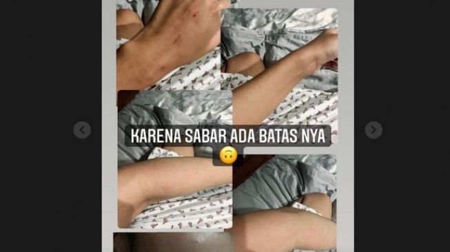 Medina Zein mengungkap luka di tangannya akibat mendapat KDRT dari sang suami, Lukman Azhari. [Instagram]