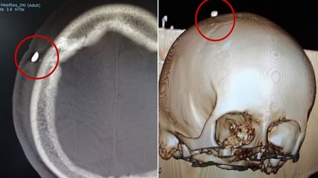 Ada gigi menancap di kepala remaja. (Daily Mail)