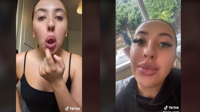 Curhat Wanita Hilangkan Filler, Sebut Bibir Berubah Mirip Nenek-nenek (tiktok.com/@lizzies_worldx)