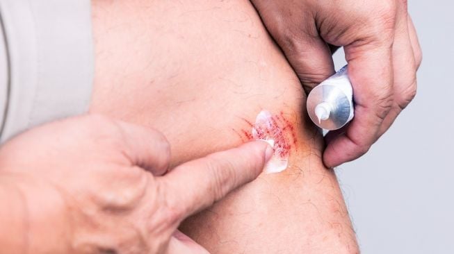 Mengenal Moist Wound Healing, Metode Penanganan Luka yang DIklaim Efektif