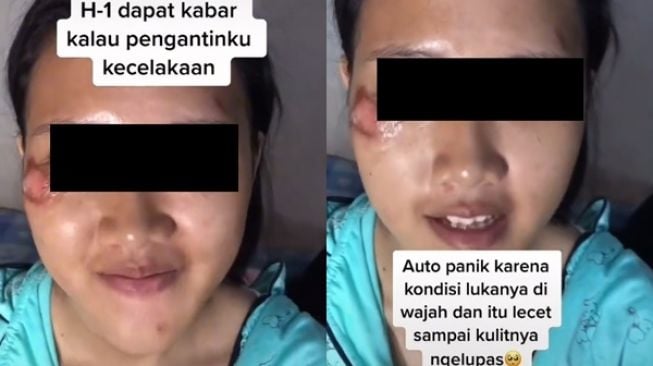 Wajah Pengantin Luka karena Kecelakaan, Hasil Riasan MUA Jadi Perbincangan