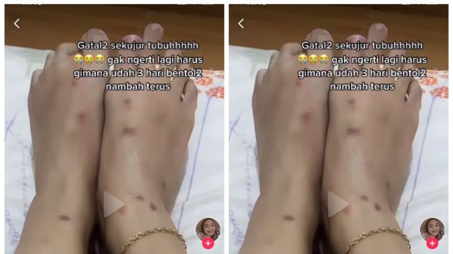 Gegara Pindah Kos, Wanita Syok Lihat Sekujur Tubuh Dipenuhi Bentol, Ternyata Karena Ini