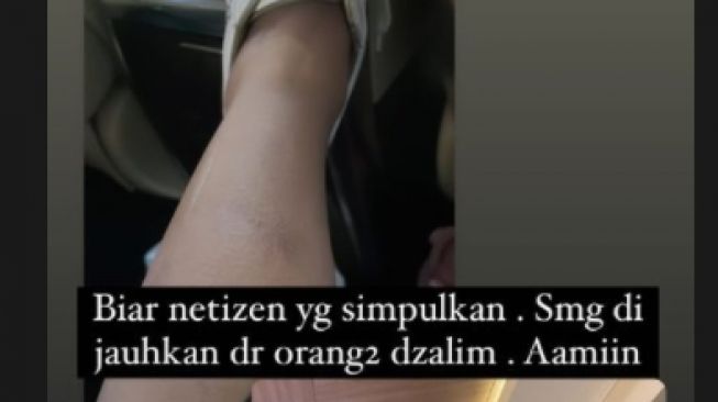 Medina Zein mengaku jadi korban pemukulan [Instagram/@medinazein]