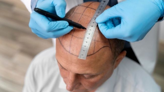 Ingin Rambut Cepat Panjang Pasca-Dicangkok? Dokter Sarankan Lakukan Terapi PRP