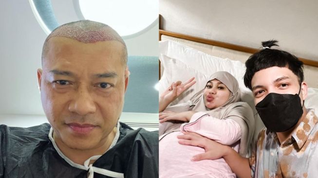 Jalani Transplantasi Rambut, Ini 5 Penampilan Terbaru Artis Indonesia