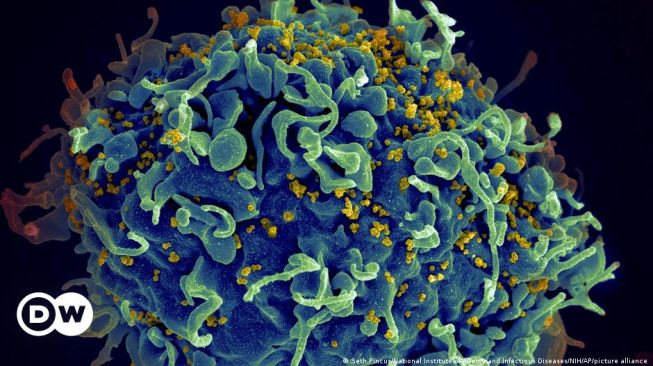 Varian Baru HIV yang Sangat Mematikan Ditemukan di Belanda