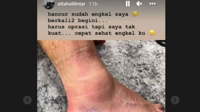 Atta Halilintar cedera di bagian kaki [Instagram/@attahalilintar]