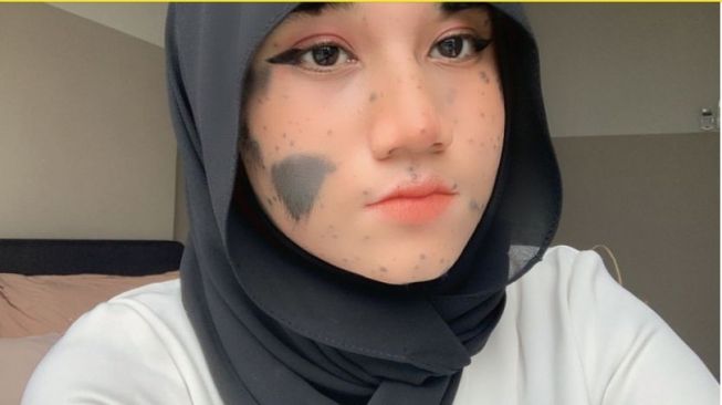 Viral Gadis Malaysia Dipenuhi Tanda Lahir di Wajah, Sering Diejek Tapi Malah Jadi 'Seleb' TikTok. (Dok: Istimewa)