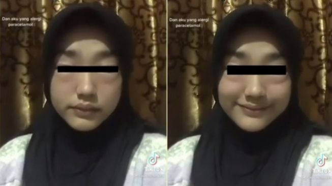 Wajah cewek ini membengkak dikira nangis seharian ternyata alergi. (TikTok/@naurasalmam)