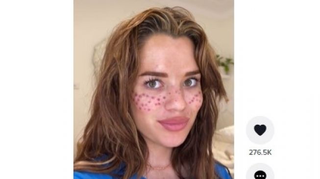 Mengerikan! Nekat Tato Freckles Sendiri Pakai Jarum Jahit, Wajah Seorang Gadis Jadi Begini