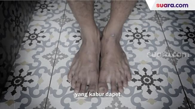 Kuku kaki Robi (bukan nama sebenarnya) yang rusak karena dipukul marti. [dokumentasi]