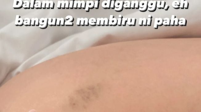 Terpopuler Kesehatan: Santet Bukan Penyebab Lebam Nora Alexandra, Profil Ketua IDI Adib Khumaidi yang Viral