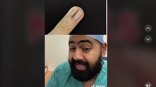 Viral di TikTok! Dokter Ungkap Tanda Penyakit Mematikan Pada Kuku, Cek Sekarang