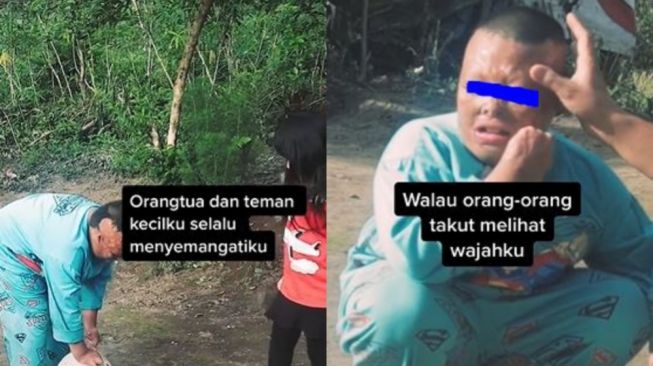 Viral Kisah Bocah Lelaki Alami Luka Bakar Hanya Punya Satu Teman Bermain