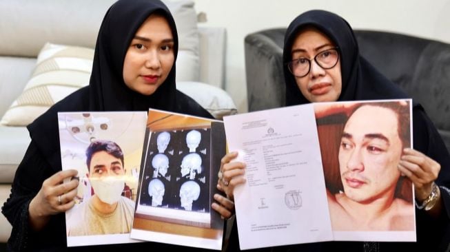 Istri Putra Siregar, Septia Siregar bersama ibunda Rico Valentino menunjukkan bukti wajah hancur Rico usai kasus pengeroyokan. [Instagram]