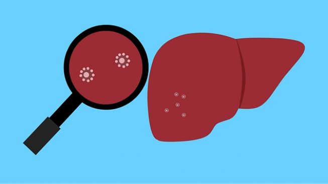 ilustrasi hepatitis - beda diare biasa dengan diare akibat hepatitis akut pada anak //pixabay.com