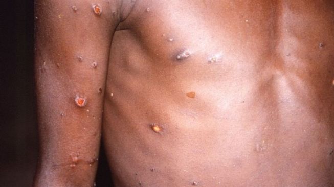 Waspada Virus Monkeypox Atau Cacar Monyet, Gejalanya Mulai Demam Sampai Kelelahan