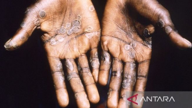 Telapak tangan pasien kasus cacar monyet dari Lodja, sebuah kota di dalam Zona Kesehatan Katako-Kombe, terlihat selama penyelidikan kesehatan di Republik Demokratik Kongo pada 1997. [ANTARA/Brian W.J. Mahy/CDC/HO via Reuters/rwa/djo]