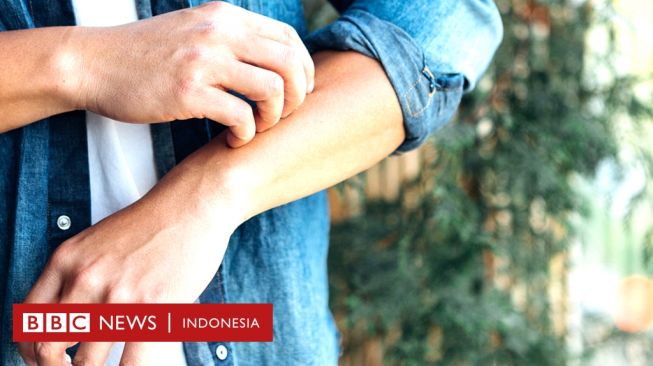 Ada Ruam di Kulit Anda? Cara Mengetahui Apakah Bercak Itu Cacar Monyet