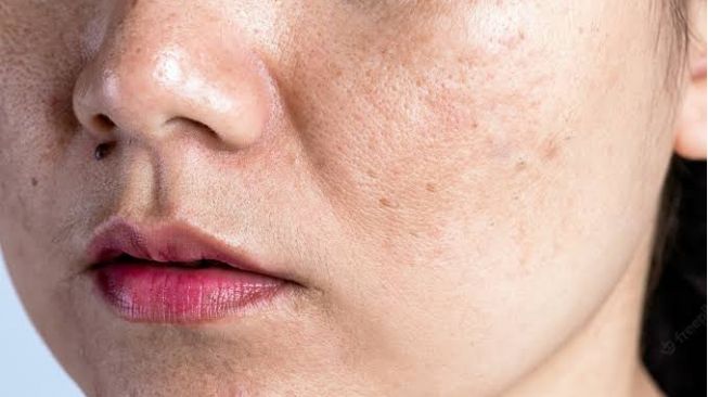 3 Cara Menghilangkan Flek Hitam di Wajah Secara Alami, Terutama di Bagian Hidung