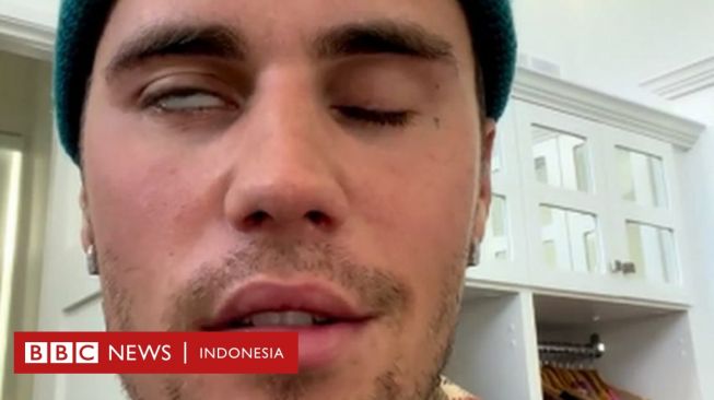 Gejala dan Bagaimana Pengobatan Penyakit Saraf Llangka Sindrom Ramsay Hunt?