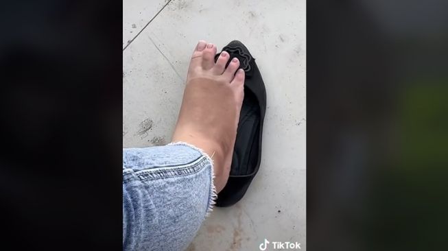 Kaki Perempuan Ini Belang karena Berkendara Siang Hari Tak Pakai Kaos Kaki, Netizen: Gosongnya 3 Jam, Hilangnya 3 Bulan