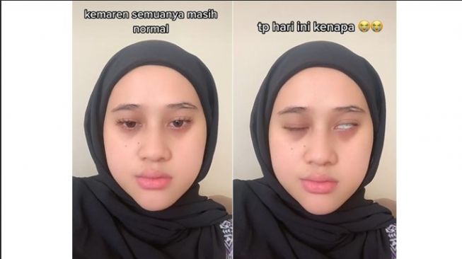 Viral! Gegara Keseringan Kena Kipas Angin, Wajah Perempuan Ini Alami Bells Palsy