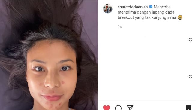 Foto: Shareefa Daanish Bagikan Video Wajah Breakoutnya, Warganet : Tetap Cantik (instagram/shareefadanish)