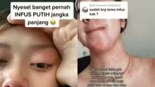 Perempuan Nyesal Suntik Putih Setelah 2,5 Tahun Muncul Merah-Merah di Kulit