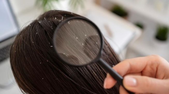Ketahui Penyebab dan Cara Mengatasi Masalah Rambut Berketombe
