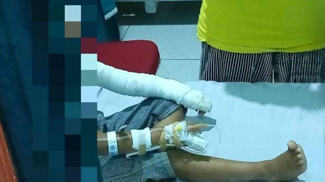 Kondisi Terkini Anak Terbakar Diduga Akibat Jajanan Ice Smoke di Ponorogo