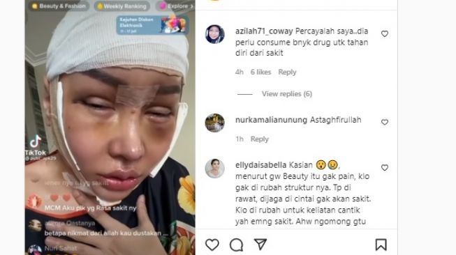 Kondisi Memprihatinkan Lucinta Luna setelah Operasi Potong Leher, Wajah Diperban dan Kesulitan Makan