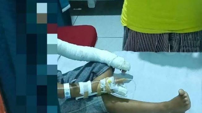 Luka Bakar di Mulut sampai Dada, 5 Fakta Bocah Terbakar Usai Jajan Ice Smoke di Ponorogo