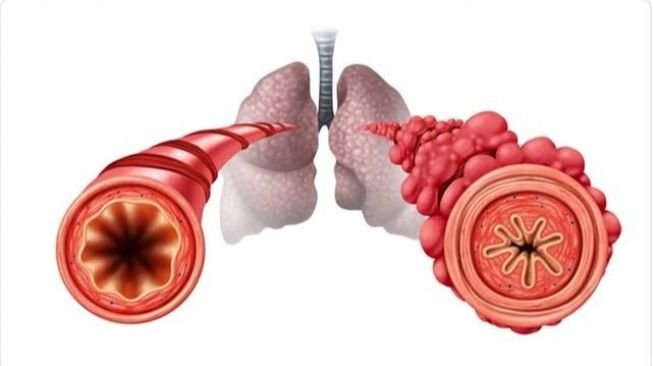 Ini Struktur dan Fungsi Bronkiolus sebagai Organ dalam Sistem Pernapasan