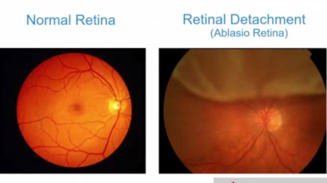 Bercak Hitam di Mata Jadi Tanda Awal Ablasio Retina, Ini Penjelasan Dokter