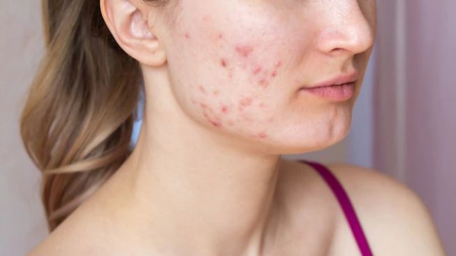 7 Rekomendasi Acne Patch untuk Mengatasi Jerawat, Mulai Rp8 Ribuan