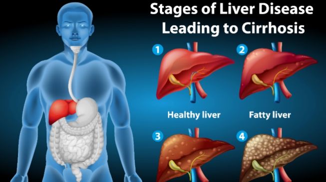 Minuman yang Disukai Banyak Pria Ini Ternyata Bisa Merusak Liver, Lho!