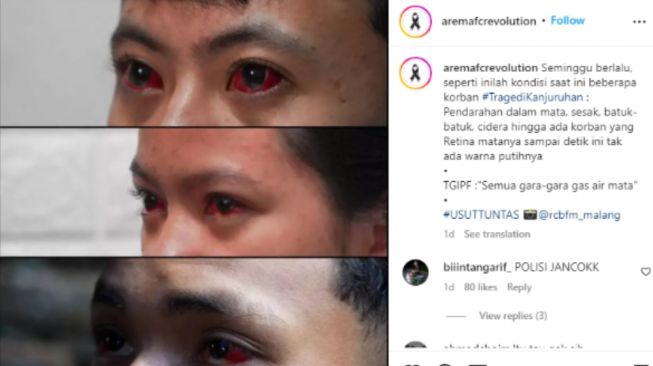 Seminggu Berlalu, Tragedi Kanjuruhan Sisakan Korban Luka Bermata Merah