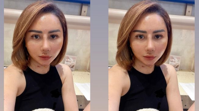 Potret Wajah Femmy Permatasari usai Oplas di Korea (Instagram/@femmypermatasari)