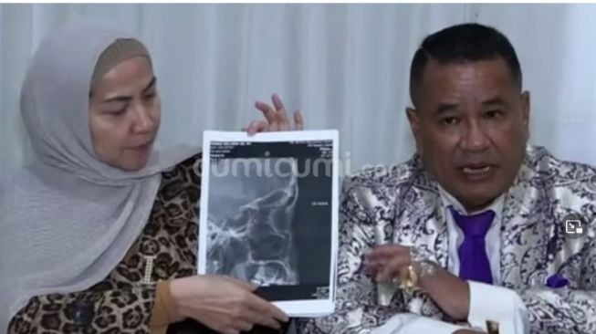 Venna Melinda didampingi Hotman Paris menunjukkan hasil visum hidungnya yang mendapat KDRT Ferry Irawan. [YouTube Cumicumi]