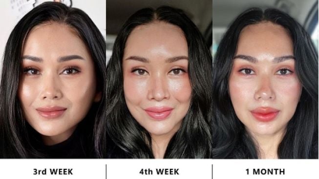 Titi DJ Dikabarkan Operasi Antiaging, Kenali Efek Samping dan Risikonya