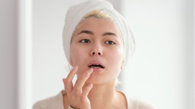 Jerawat Muncul di Bibir? Ini 6 Tips untuk Mengatasinya