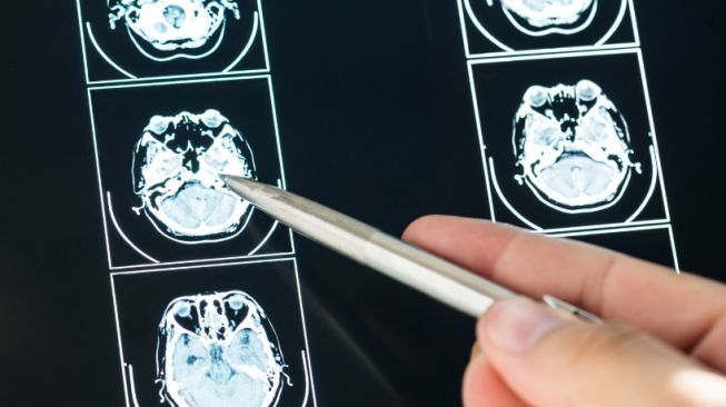 Mengenal Cerebral Atrophy, Penyakit yang Menyebabkan Ukuran Otak Mengecil