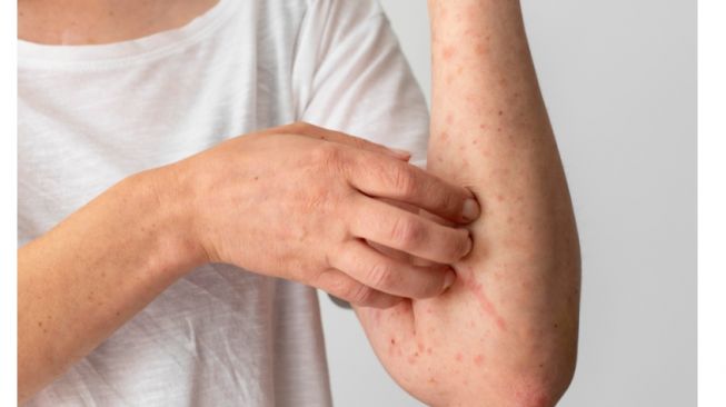 Illustration of skin showing an allergic reaction.  (Freepik)